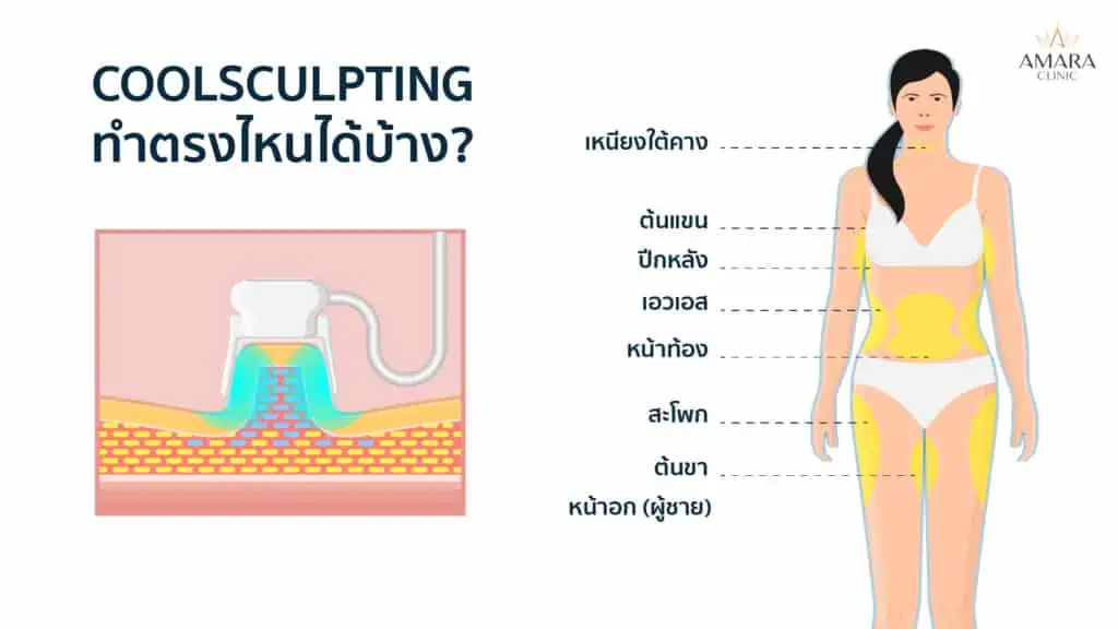 Coolsculpting