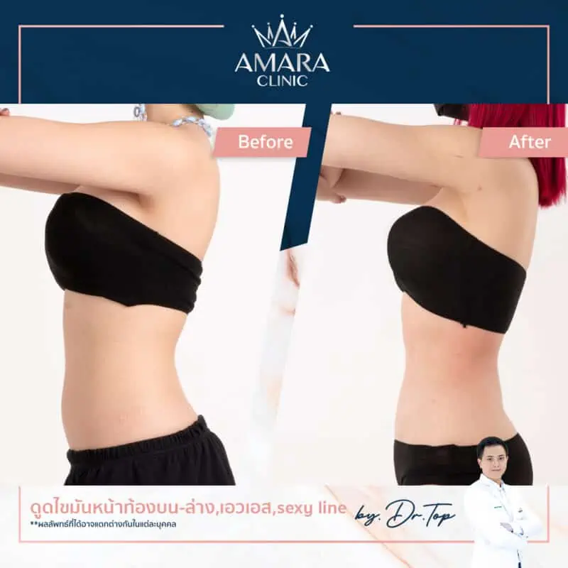 liposuction in thailand - amara