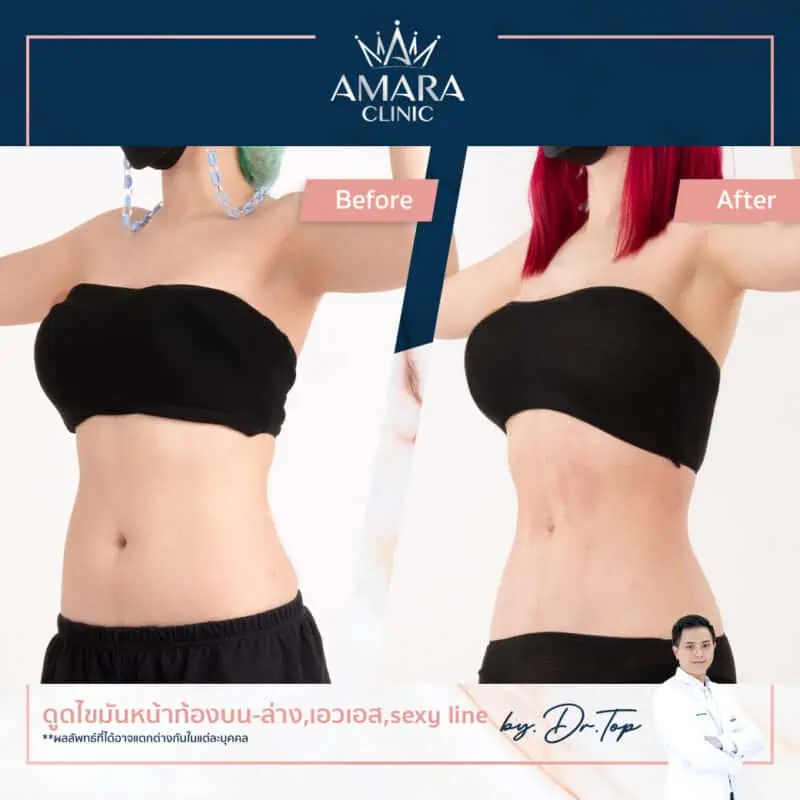 BA liposuction - sexyline