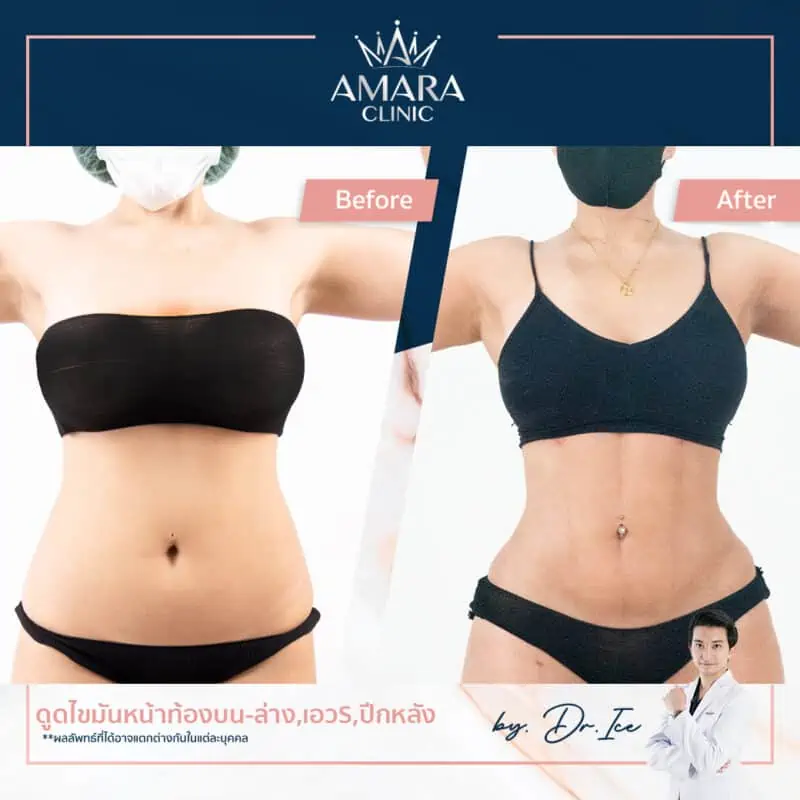 review liposuction in thailand