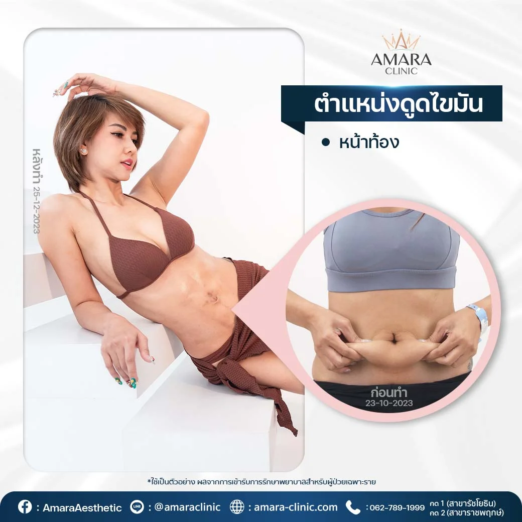 ดูดไขมันเทคนิค Advanced LipoSculpt 4D