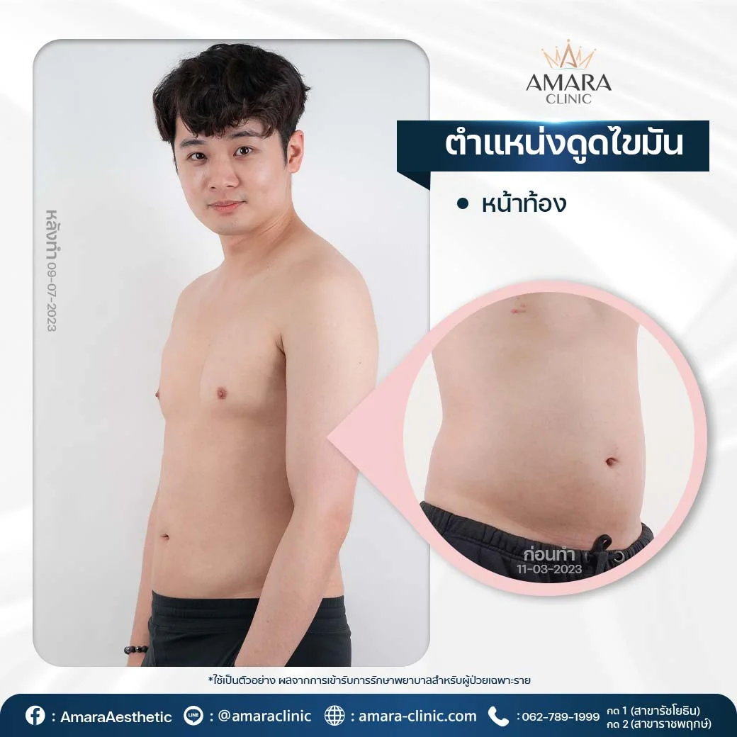 liposuction in Bangkok