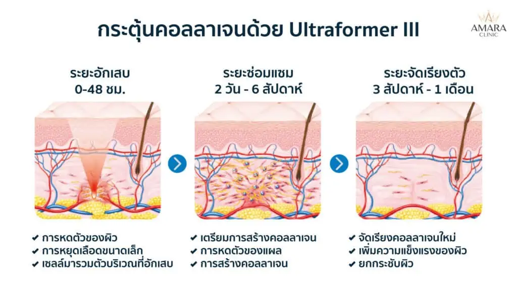 Ultraformer III