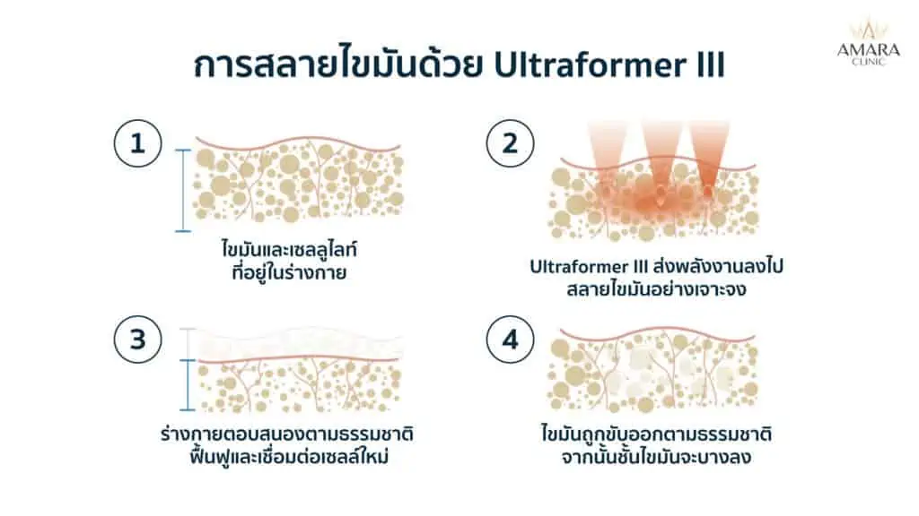 Ultraformer III