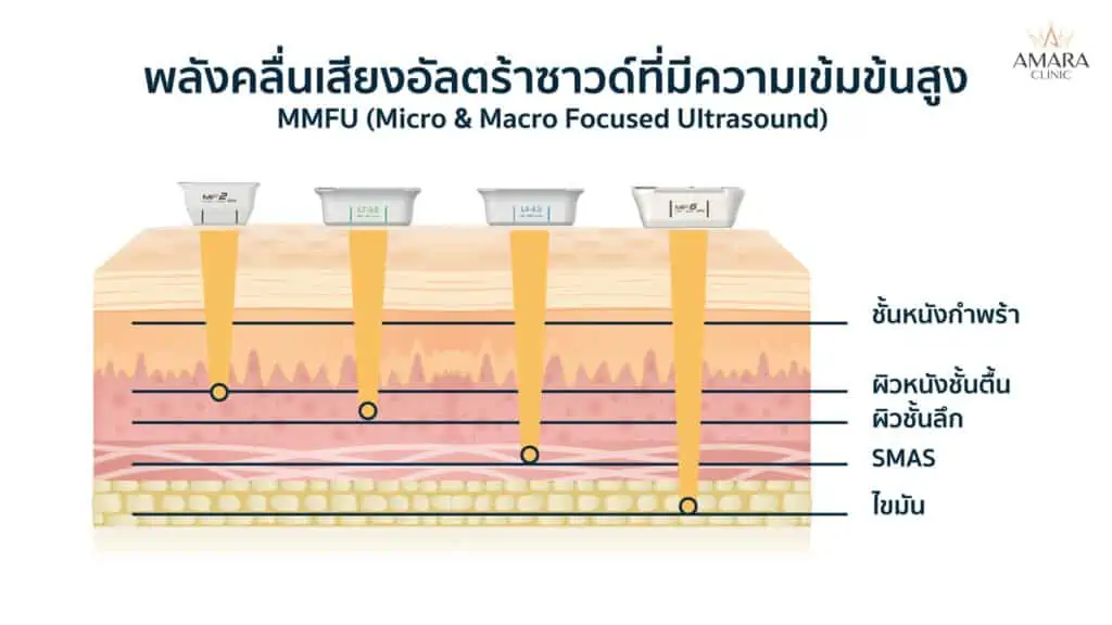 Ultraformer III