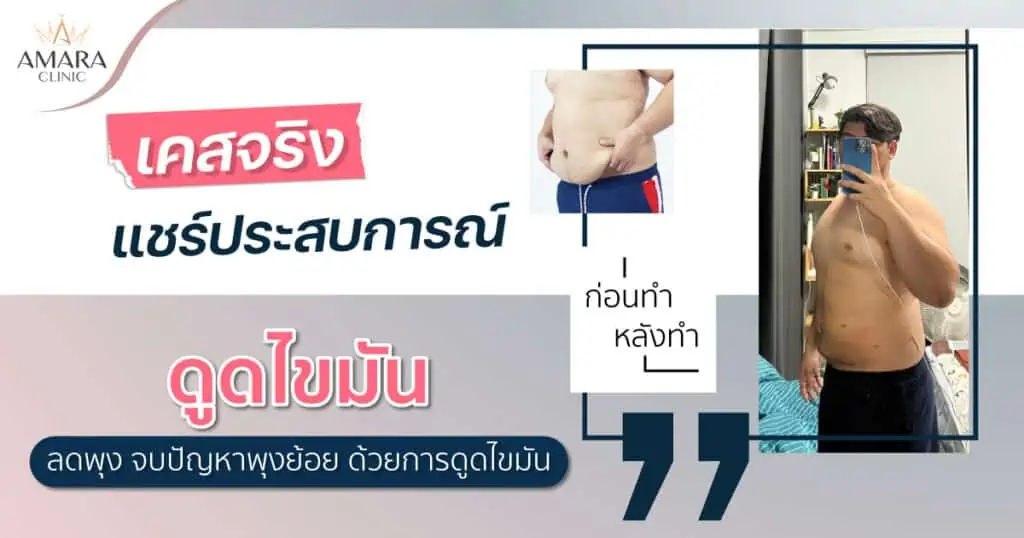 ลดไขมันหน้าท้องผู้ชาย