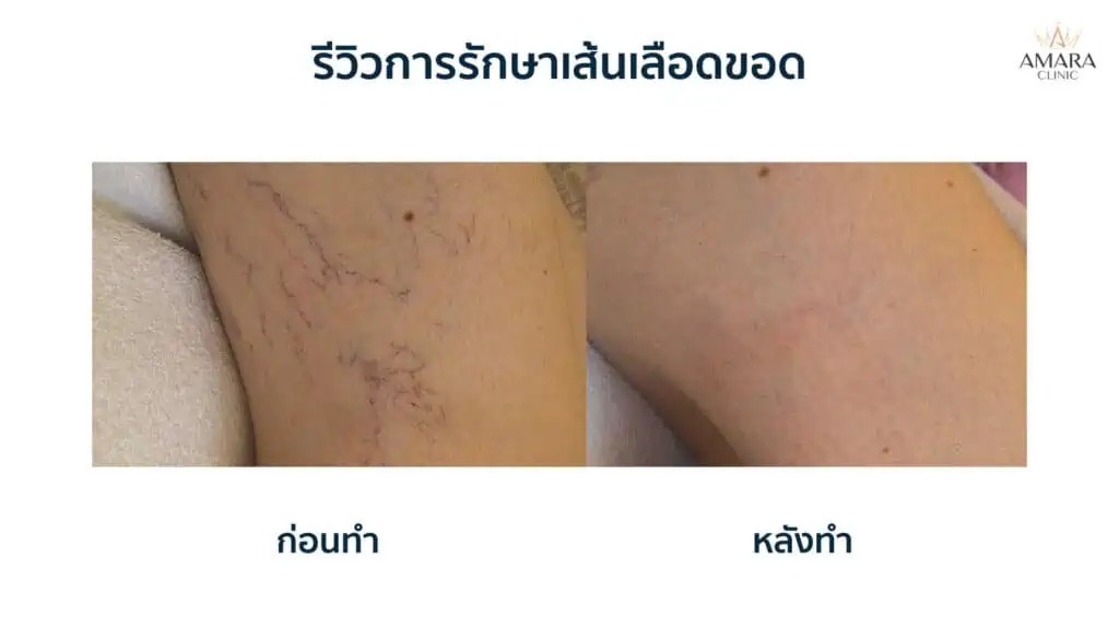 MeDioStar เลเซอร์ขน