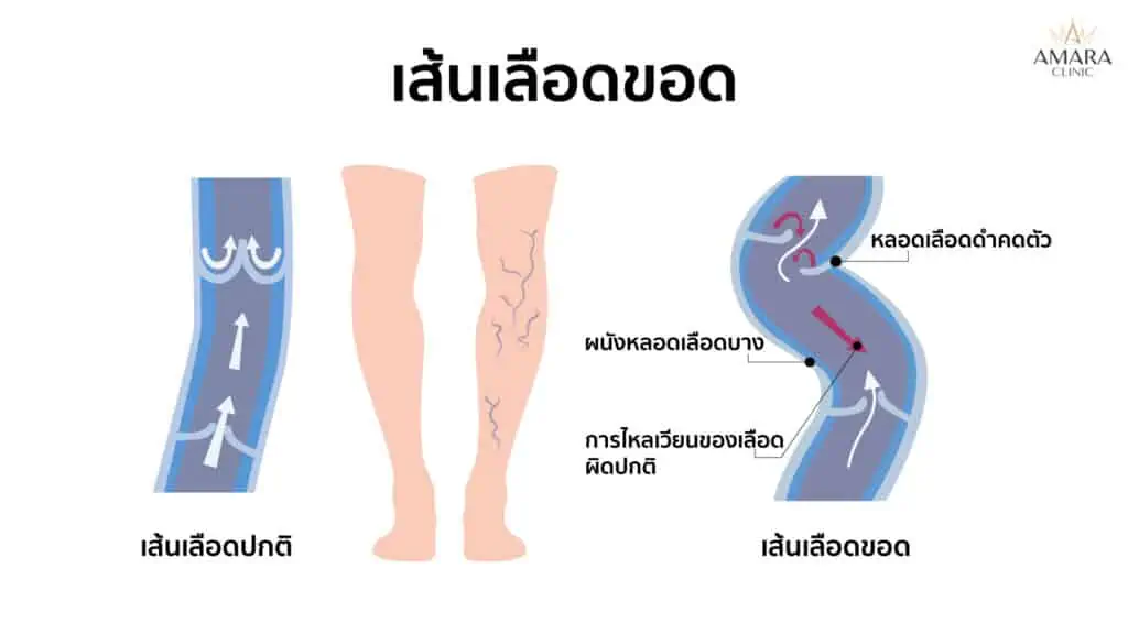 เส้นเลือดขอด