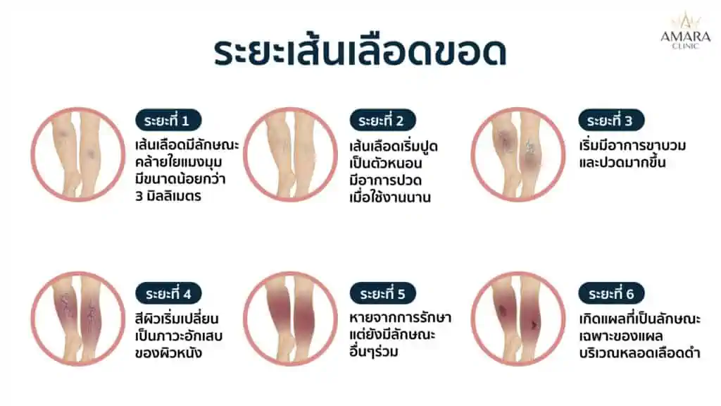 เส้นเลือดขอด