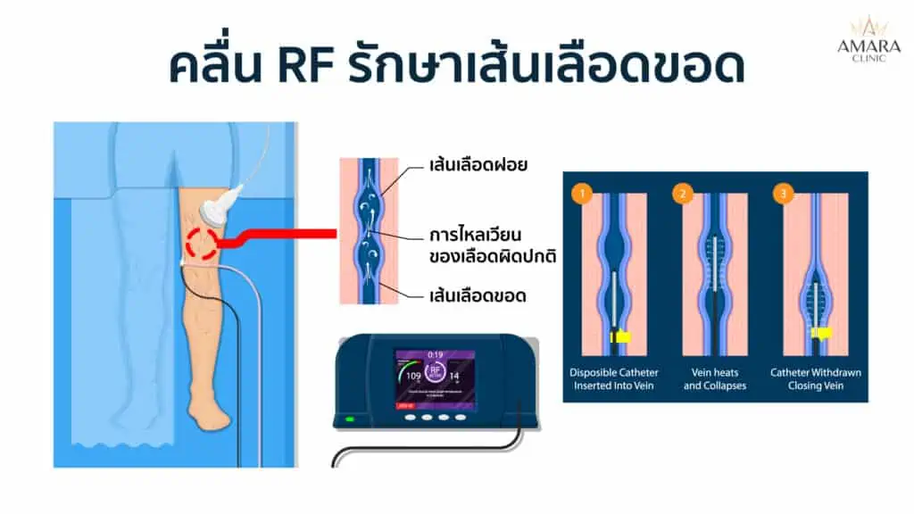 เส้นเลือดขอด