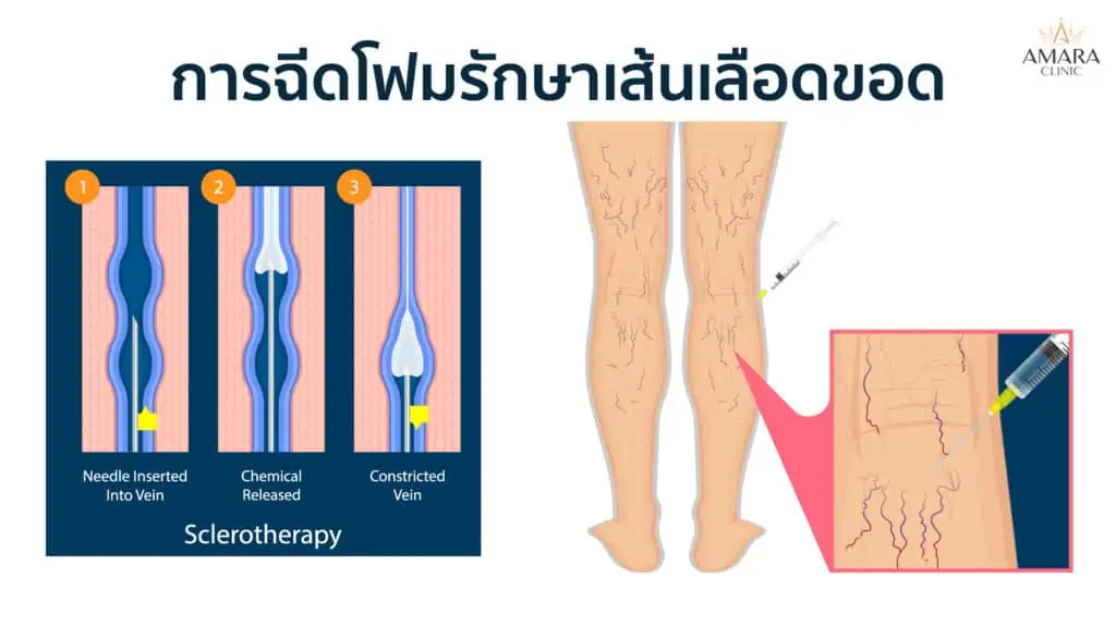 เส้นเลือดขอด