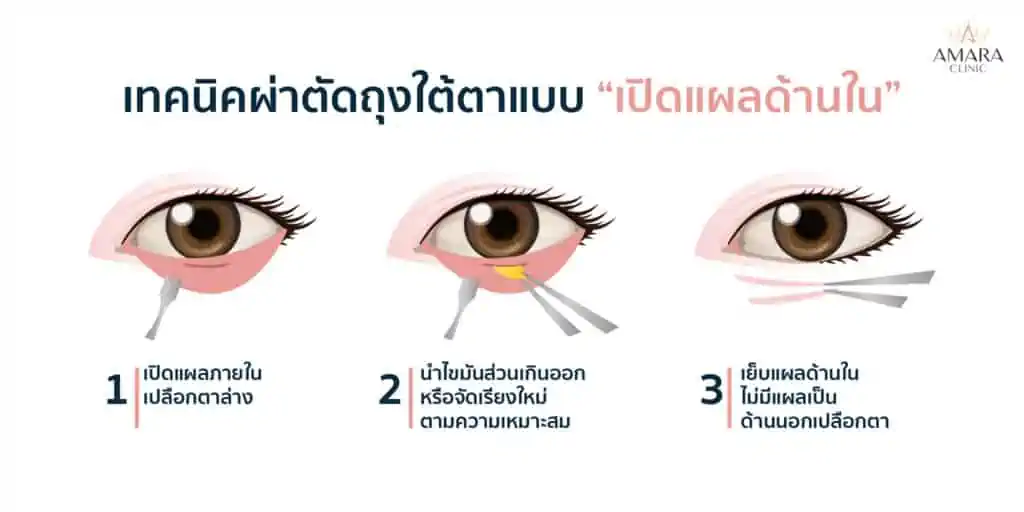 รักษาถุงใต้ตา