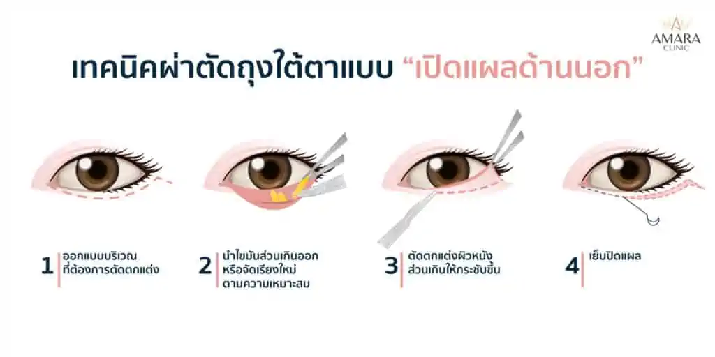 รักษาถุงใต้ตา