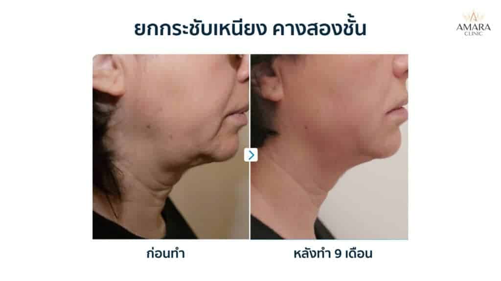 ตัวผอมแต่หน้าอ้วน เรื่องกลุ่มใจของคนตัวเล็ก