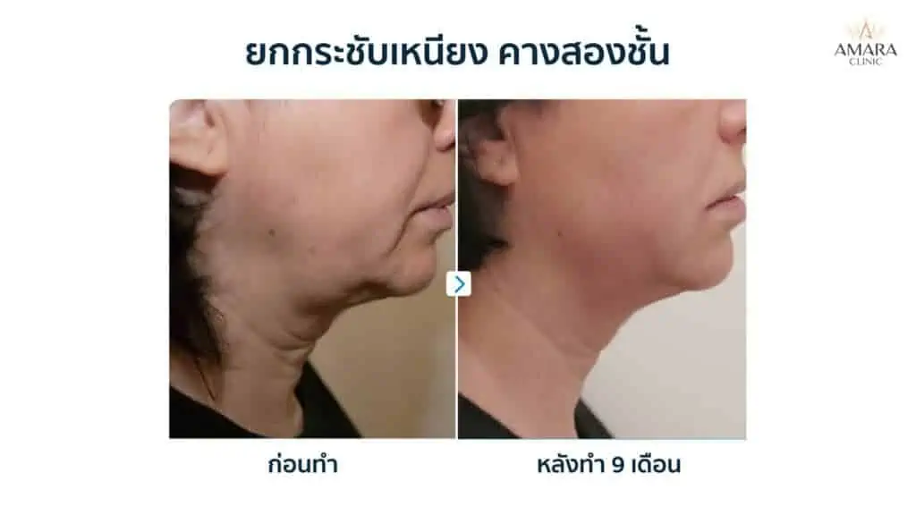 ตัวผอมแต่หน้าอ้วน