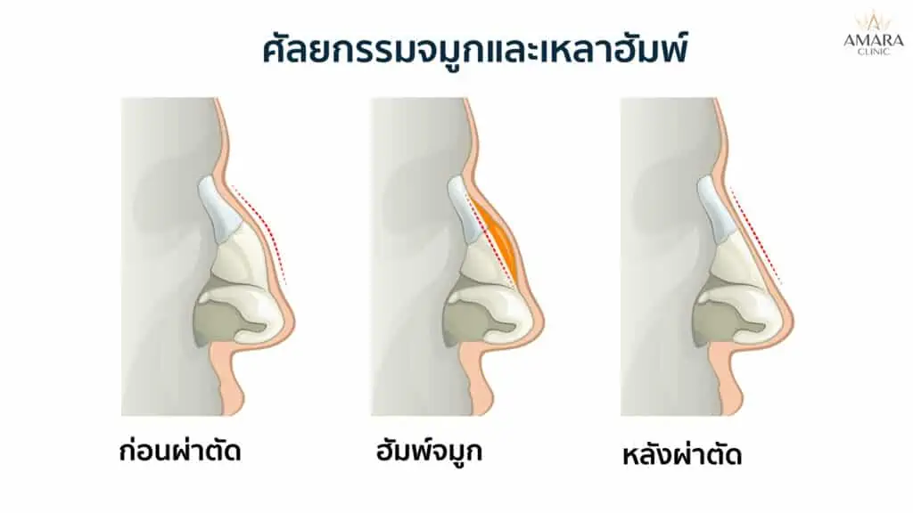 ฮัมพ์จมูก