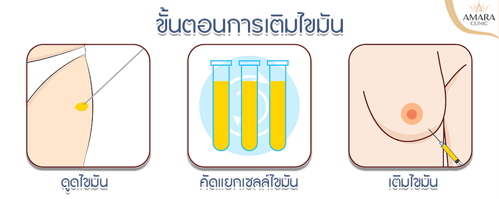 ฉีดไขมัน เพิ่มขนาด