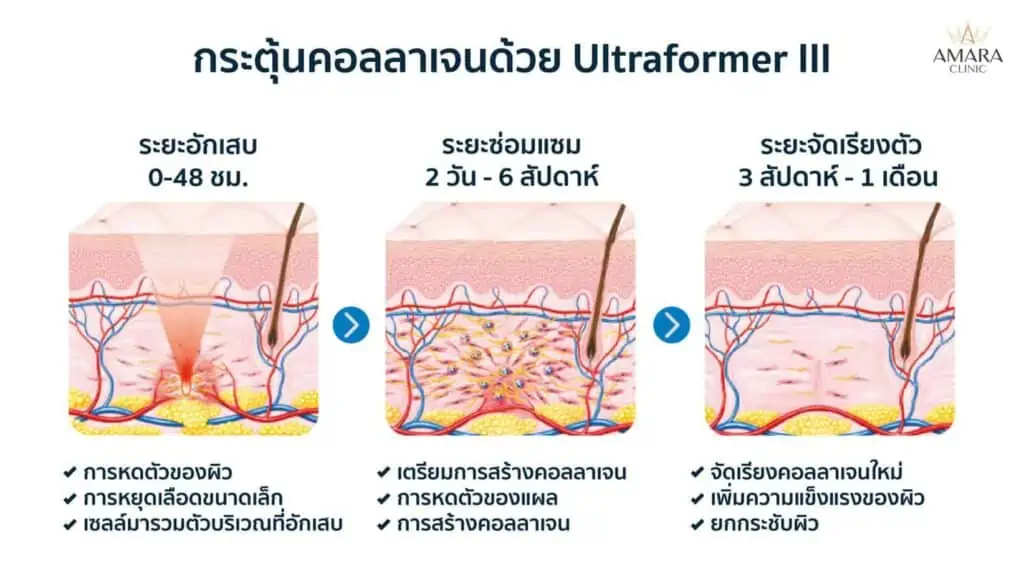 วิธีลดเหนียง