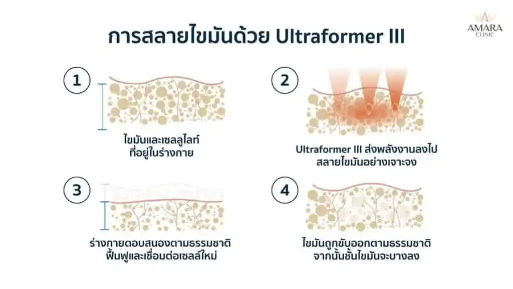 วิธีลดเหนียง