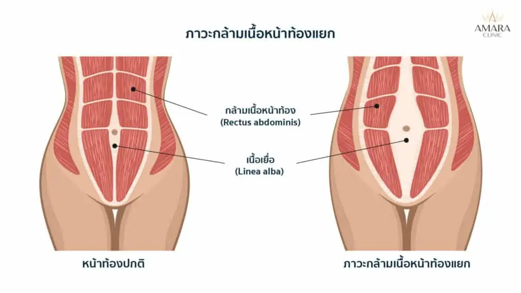 หน้าท้องย้วยหลังคลอด