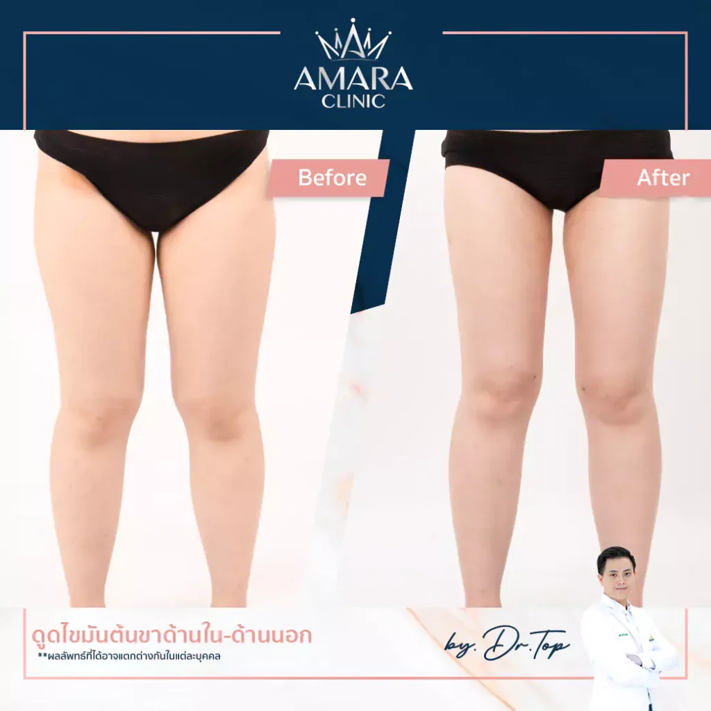 สาวขาใหญ่ แต่งตัวยังไงให้ขาเรียวเล็กในพริบตา! พร้อมทริคขาเรียวที่ต้องรู้!!