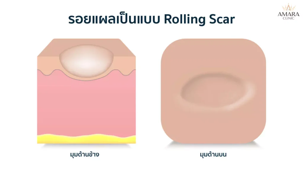 รักษารอยสิวที่หลัง ภายใน 7 วัน