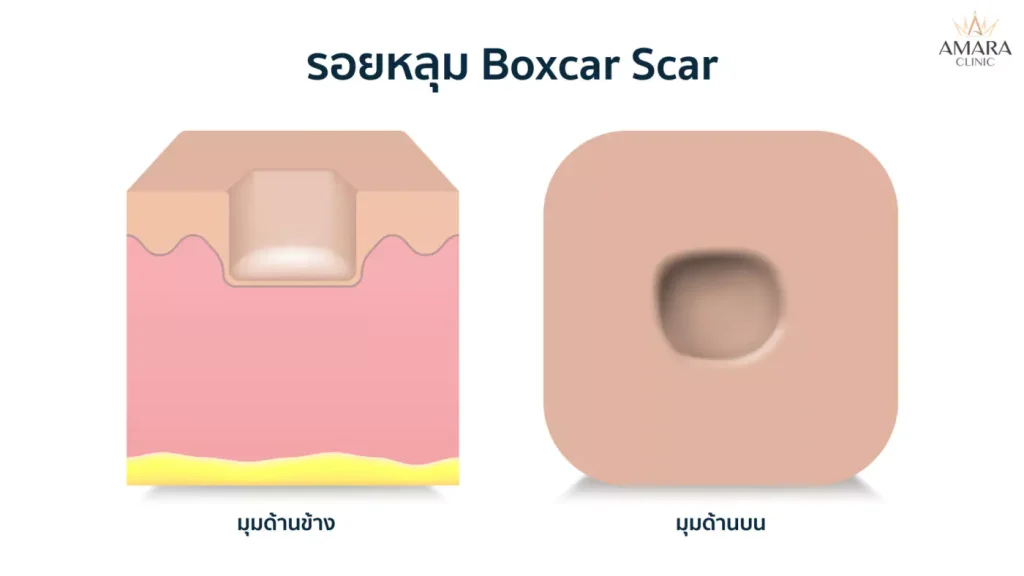 รักษารอยสิวที่หลัง ภายใน 7 วัน