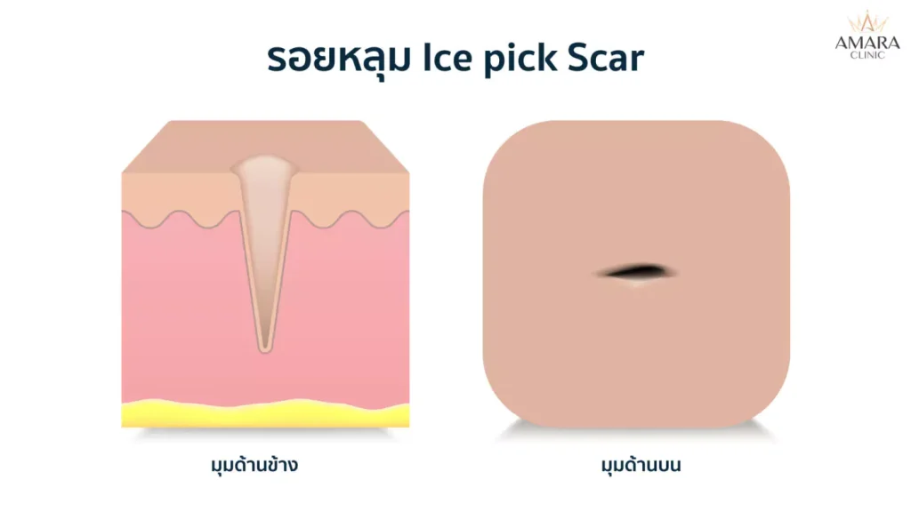 รักษารอยสิวที่หลัง ภายใน 7 วัน