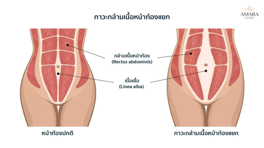 พุงป่อง