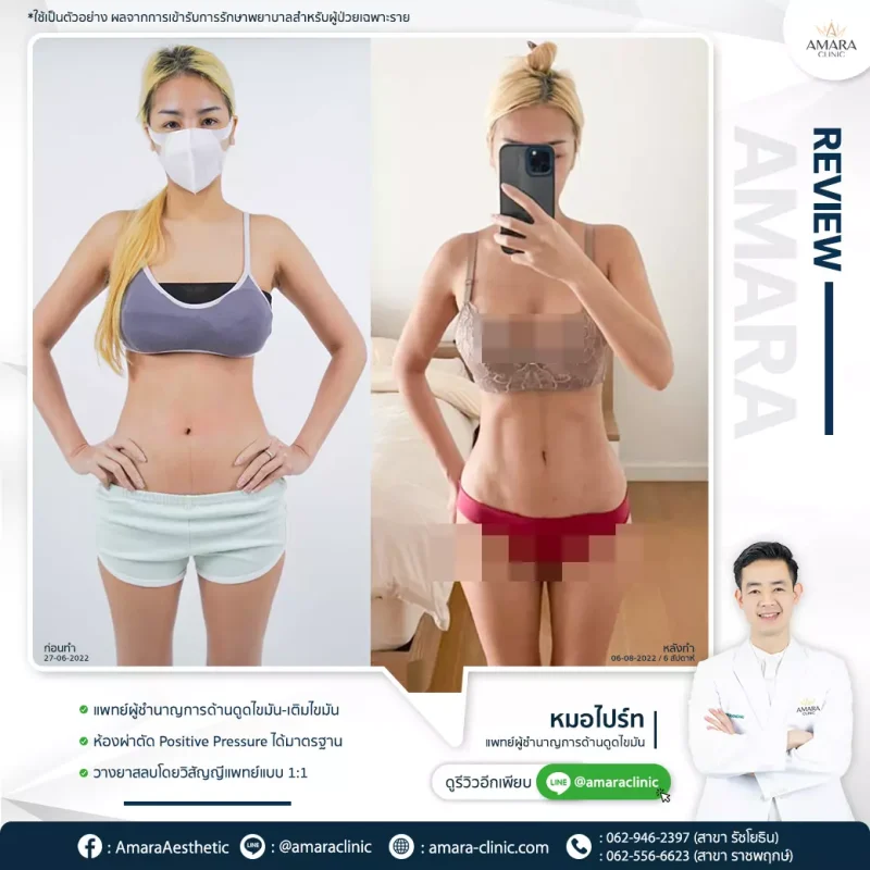 รีวิว ดูดไขมันเทคนิค Advanced LipoSculpt 4D - AMARA