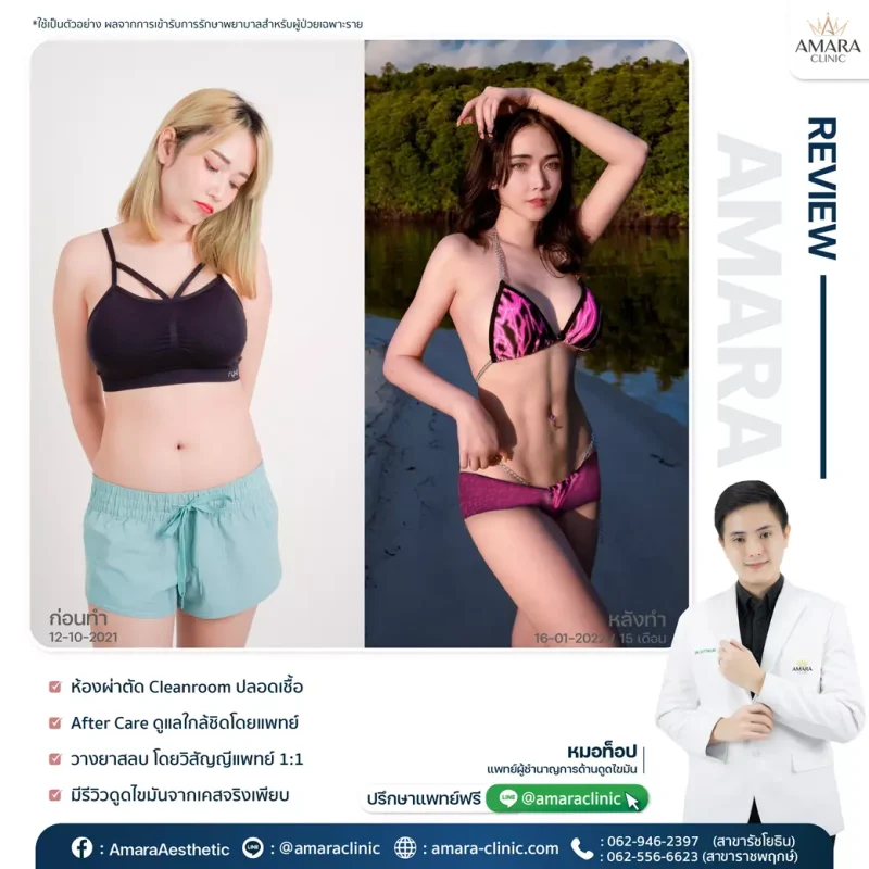 ดูดไขมันเทคนิค Advanced LipoSculpt 4D