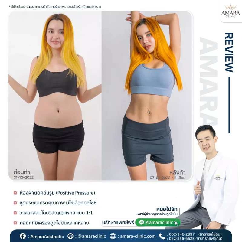 ดูดไขมันเทคนิค Advanced LipoSculpt 4D - AMARA