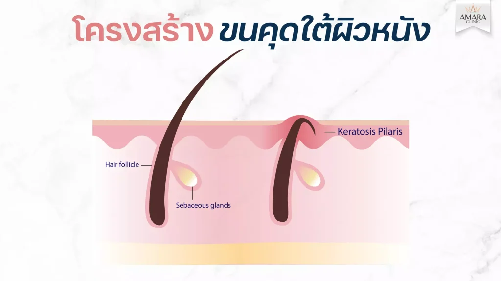 ขนคุดที่น้องสาว เกิดจากอะไร! จัดการขนคุดรอบบิกินี่อย่างไรดี?