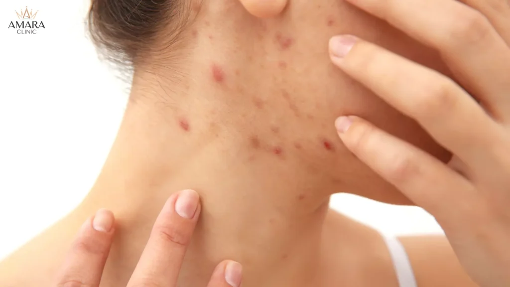 causes of jawline acne 5