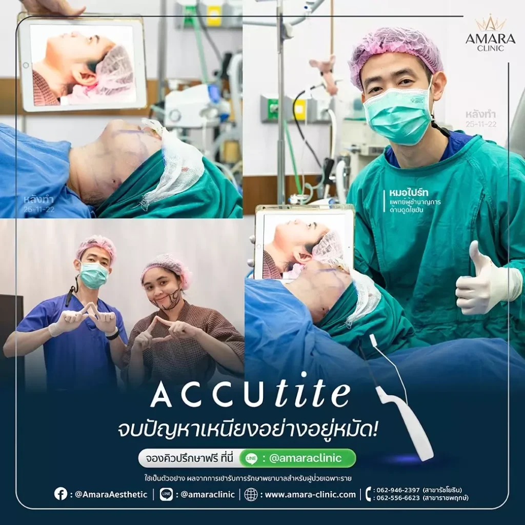 ดูดไขมันเหนียงด้วย accutite