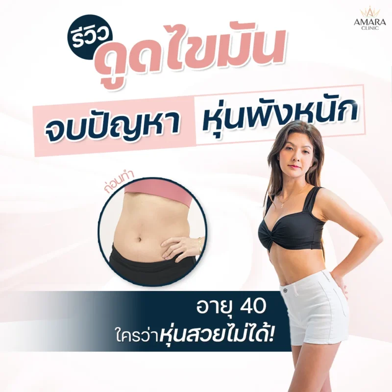 รีวิวดูดไขมันอายุ 40