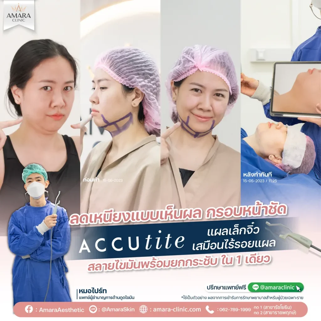 ทำ accutite ที่ไหนดี