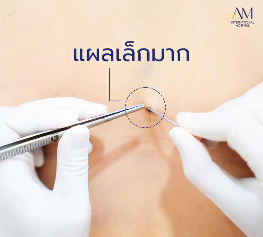 แผลจากการดูดไขมัน