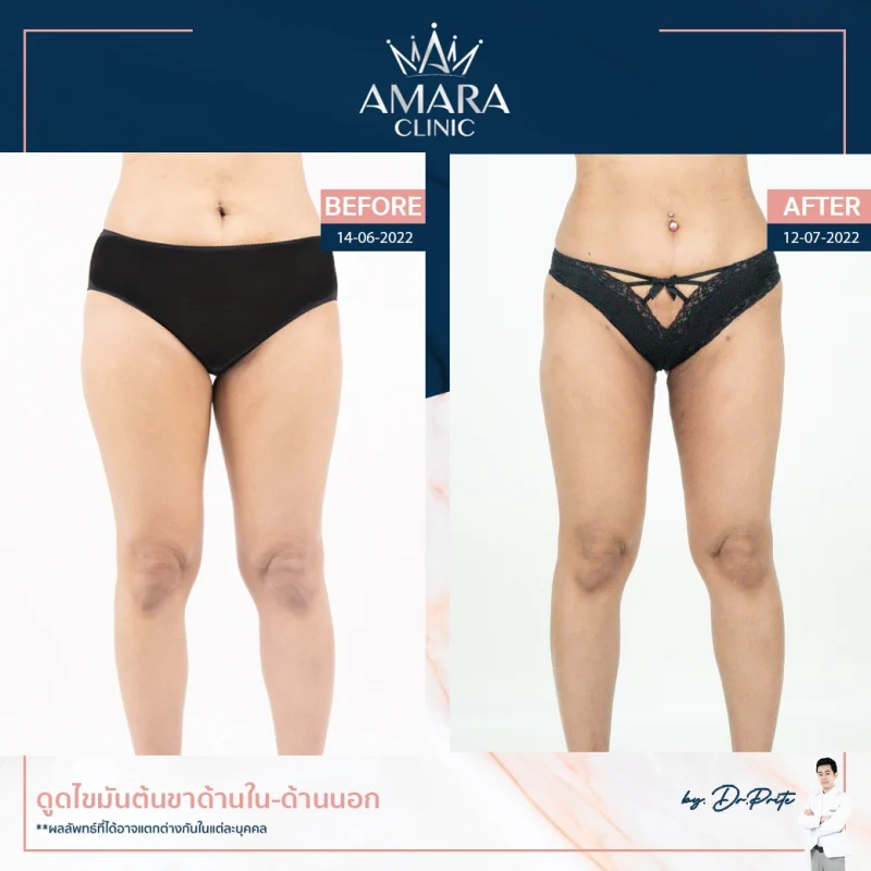 review liposuction in thailand - legs 1