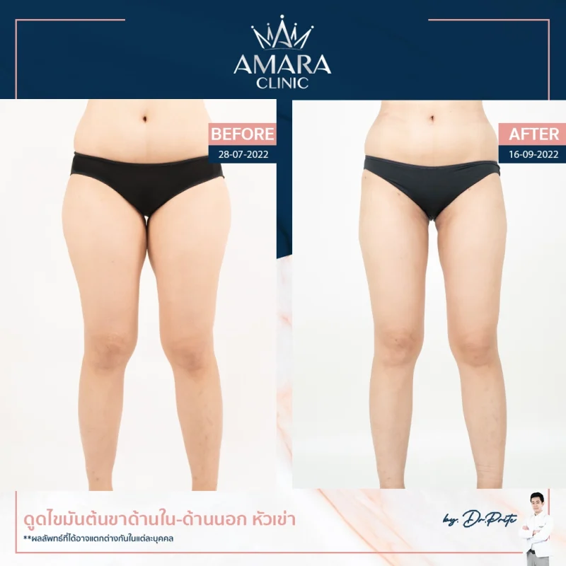 ลดขาเบียด review liposuction in thailand - legs