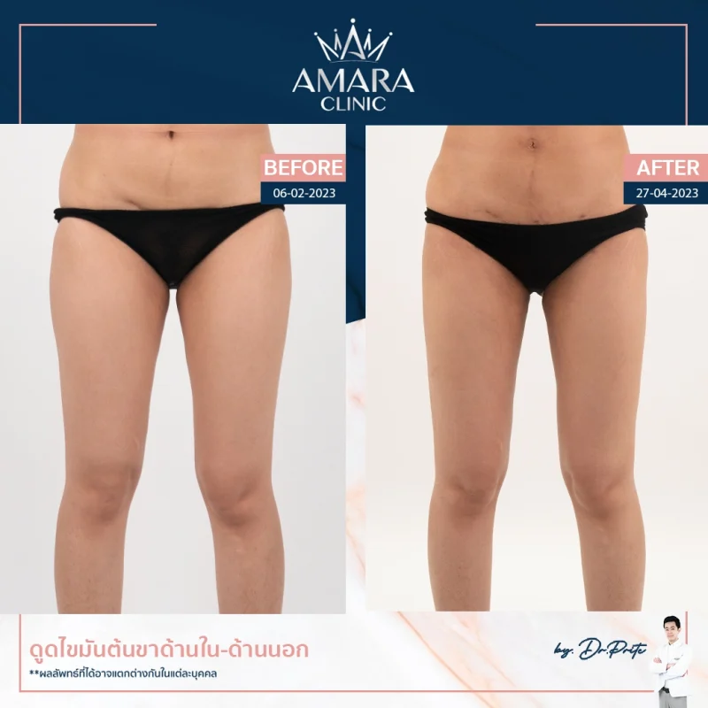 review liposuction in thailand - legs 2
