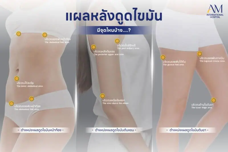 แผลดูดไขมัน อยู่ตรงไหน