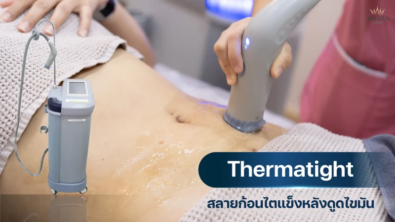 นวดสลายก้อนแข็งไตหลังดูดไขมัน thermatight