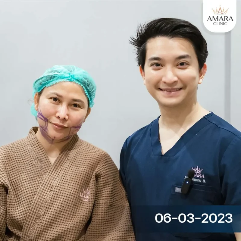 face liposuction by dr.ice amara