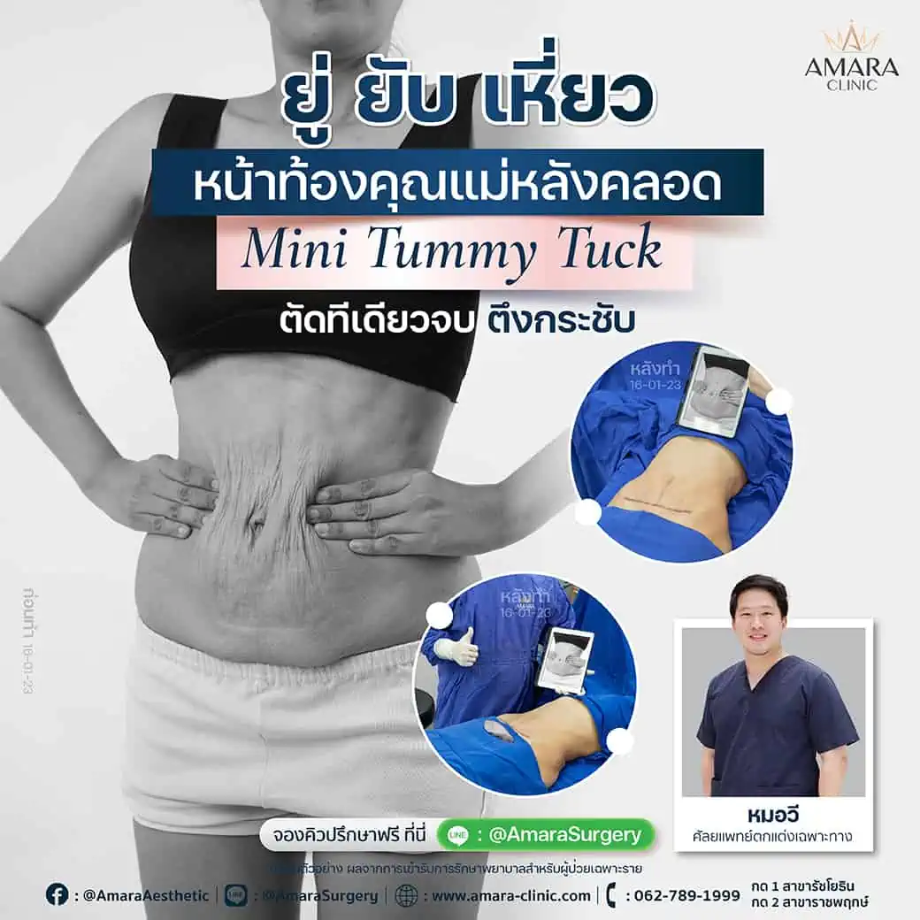 Tummy tuck