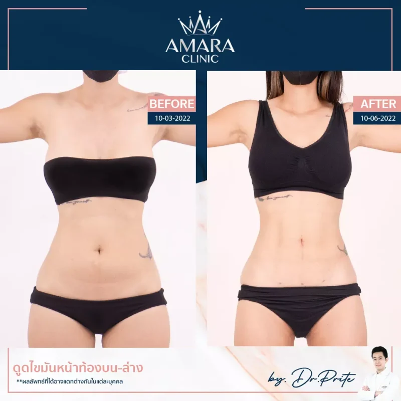 Abdominal Liposuction - ดูดไขมันหน้าท้อง