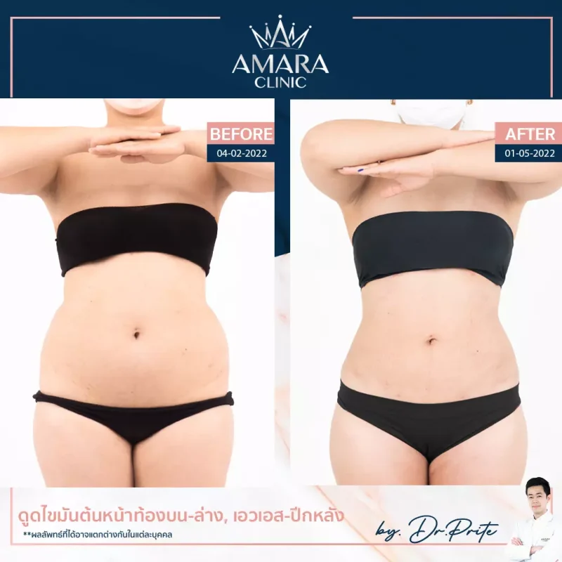 Abdominal Liposuction - ดูดไขมันหน้าท้อง ที่ เอมาร่า