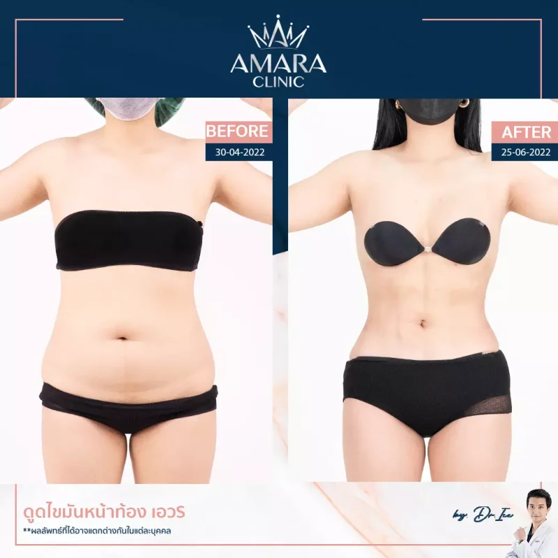 ดูดไขมัน vaser liposuction