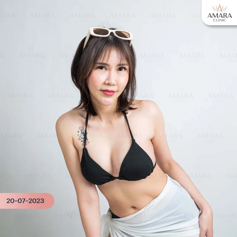 breast augmentation at amara