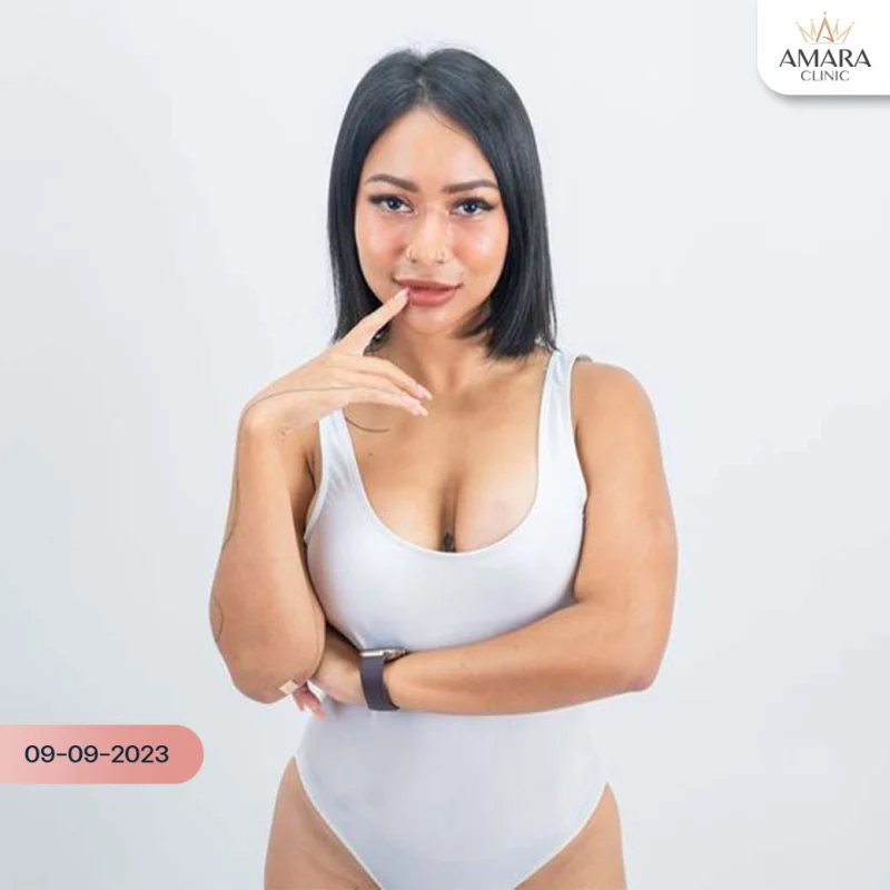 breast augmentation review - รีวิว หลังทำนม